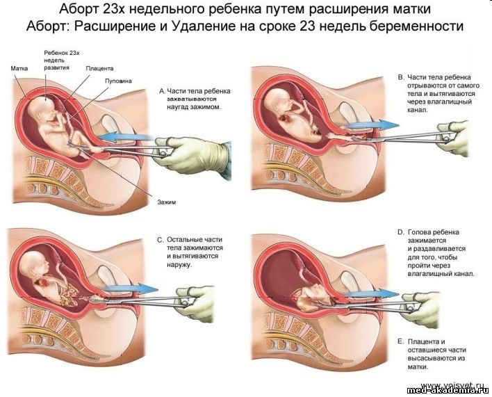 Аборт - это искусственное прерывание беременности